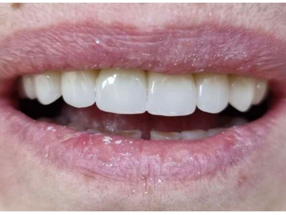 Pacijent pre i posle protetske nadoknade zuba u ordinaciji Dental Perfect
